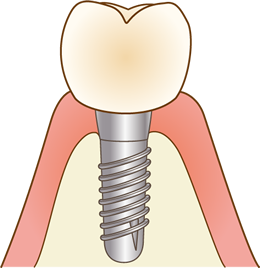 インプラントついて
