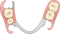 部分入れ歯
