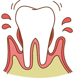 歯周病について