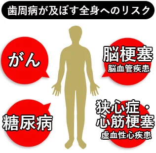 歯周病が及ぼす全身へのリスク